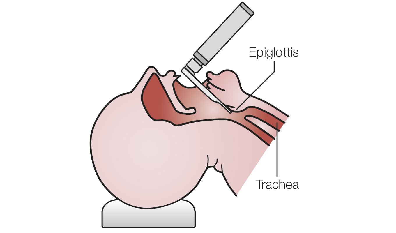 Intubation mit HEINE Miller Spatel